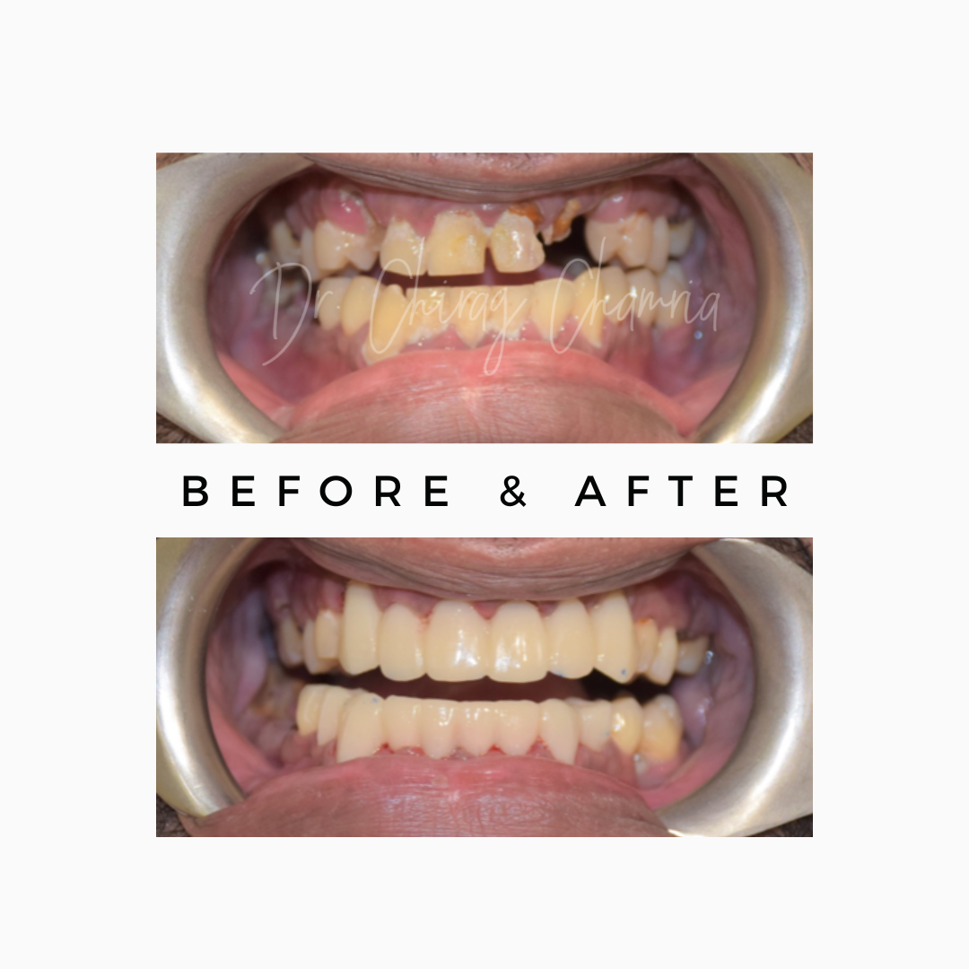 Full Mouth Dentist in Mumbai